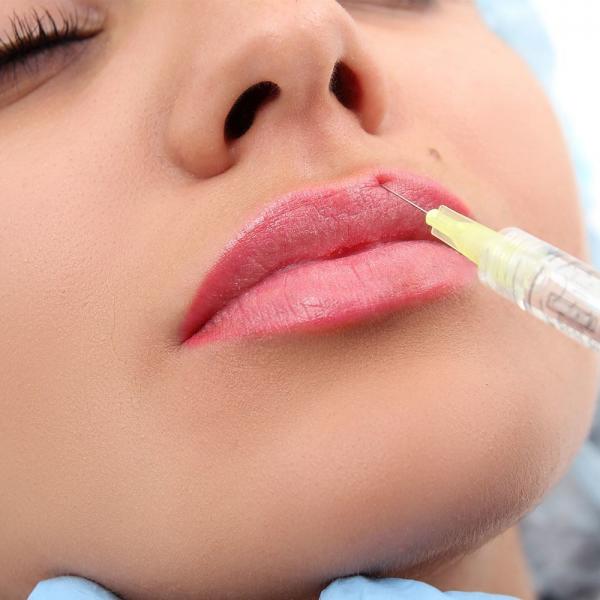 Augmmentation Hyaluronic Acid Lip Injections Natural Looking Plump Lip