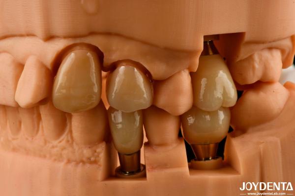 Quality Customizable Implant Crown and Bridge Achieve a Natural Look with Long-lasting Results for sale