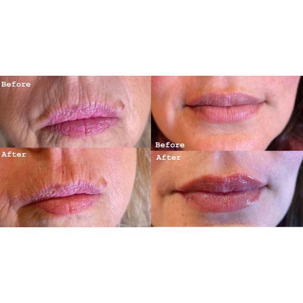 Hyaluronic Acid Dermal Filler Lip Injections 1ml 2ml 5ml Derm Lip Implants