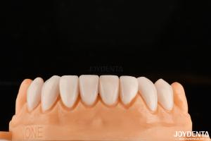 Strong Bond With Tooth Enamel For Secure Fit Dental Veneers Customization For Personalized Shades To Match Natural Teeth