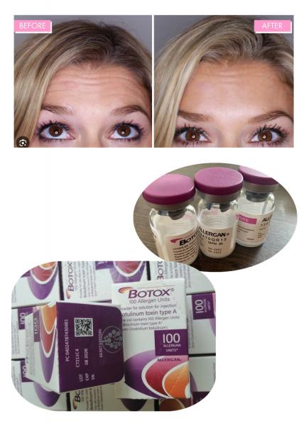 Anti Wrinkle Botulinum Toxin Allergan 100IU 150iu Botox Injections Xeomin' Nabotox