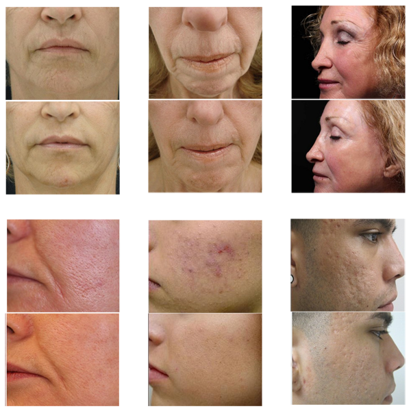 Thermal RF Fractional max 50MHz high rf output skin treatment safety and easy assignment radio frequency face lift