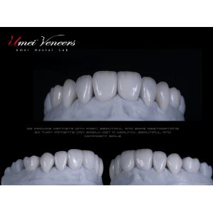 Natural Whitening Hollywood Veneers
