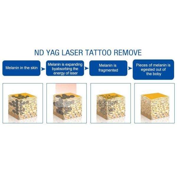 6 * 140mm Lamp Laser Tattoo Removal Machine 532nm Easy Operation CE Certification