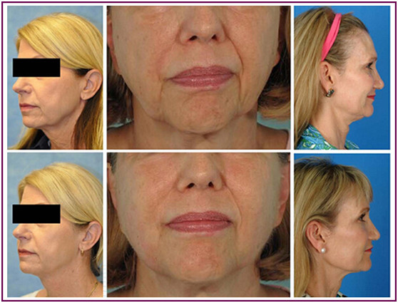 Painless Safe HIFU Machine Long Lasting Used In Acne Removal