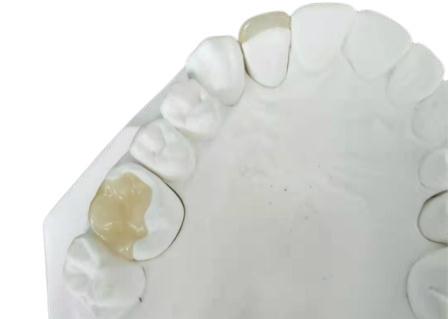 Quality Durable Flexible PFM Bridge Crown Dental IPS E Max Press Inlay Onlay for sale