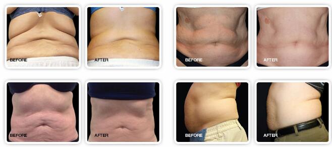 GOMECY Non Contact Type Fat Melting Body Heavy Weight Loss no BMI Limitation Beauty Machine