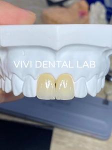 China Accurate Dental Lab Crowns Ivoclar Esthetic Zirconia Crowns Natural Looking wholesale