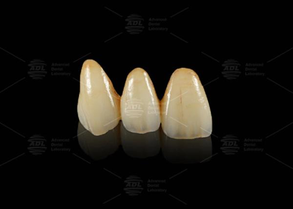 Quality Durable Hypoallergenic EMAX Bridge Extreme Esthetics Emax Dental Bridge for sale