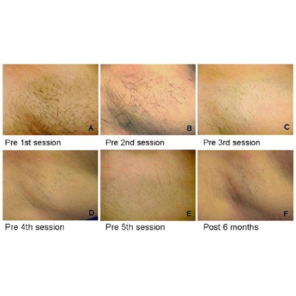 Beauty Market Most Classic machine 808nm diode laser hair removal NBW-L121