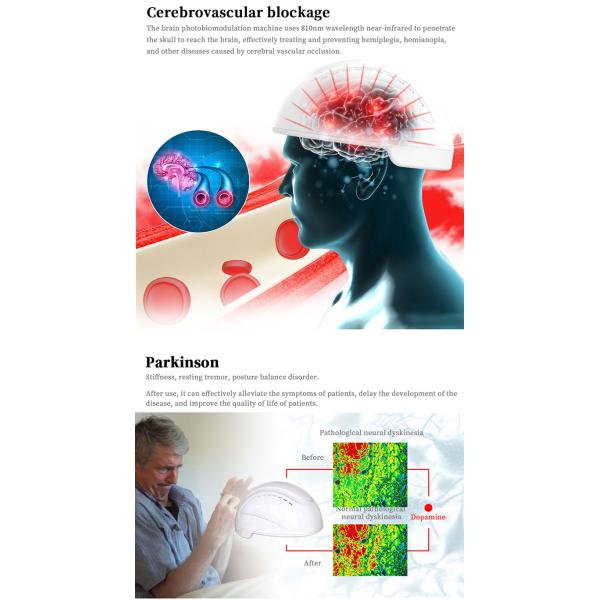 Transcranial Magnetic Brain Stimulation Neurofeedback Therapy Machine