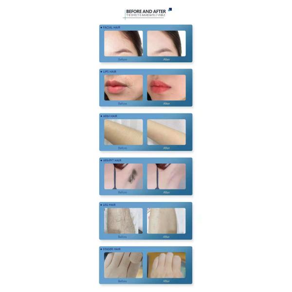 1800W FDA Approved 808 Diode Laser Hair Removal Machine 2in1 Pico