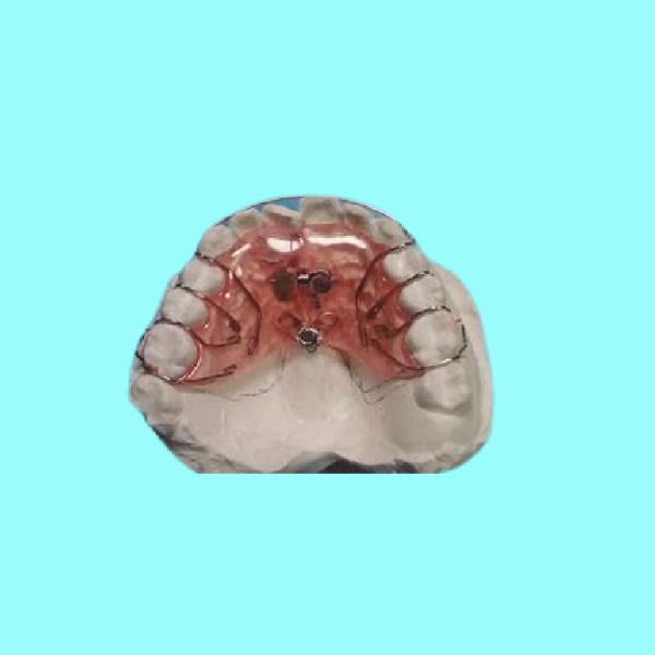 Safe Fixed Aligners Easy Cleaning Removable Fixed Orthodontic Braces