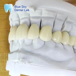 Translucent Layered Zirconia Crown Dental Restoration Multilayer Zirconia Crown