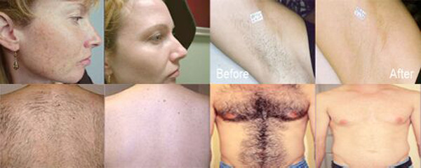 Ipl photofacial machine for home use laser machine price for sale