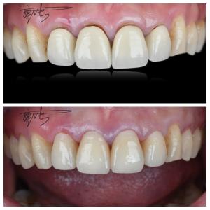 Comfortable Zirconia Dental Bridges Lightweight Natural Color Transitions For Optimal Patient Experience