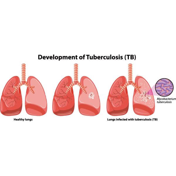 99% Tuberculosis Rapid Test Kit