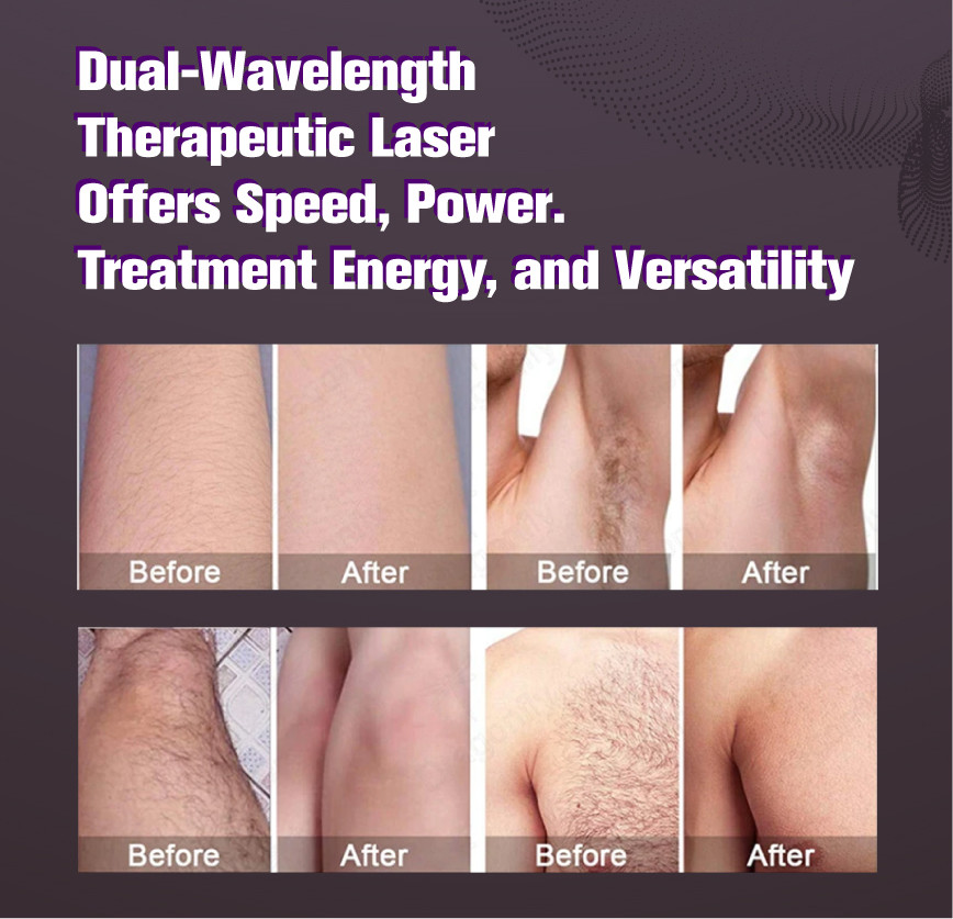 Nd Yag Candle Alexandrite Laser Machine Hair Removal With Mdsap