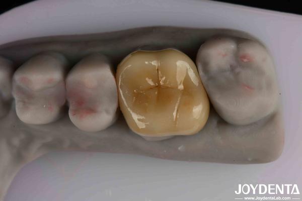Quality Easy To Clean And Durable Emax Inlay Onlay Resistance To Staining For Optimal Performance for sale