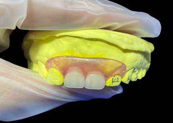 Quality Tailored Secure Fit invisible Flexible Parital Denture Replacement For Comfortable Chewing And Speaking for sale