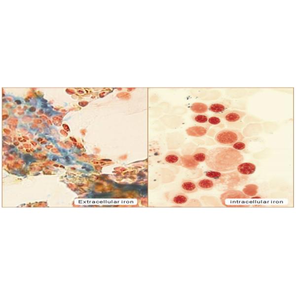 5Tests 20Tests 100Tests Iron Stain Kit For Staining Bone Marrow Cell And Bloodcell Smear