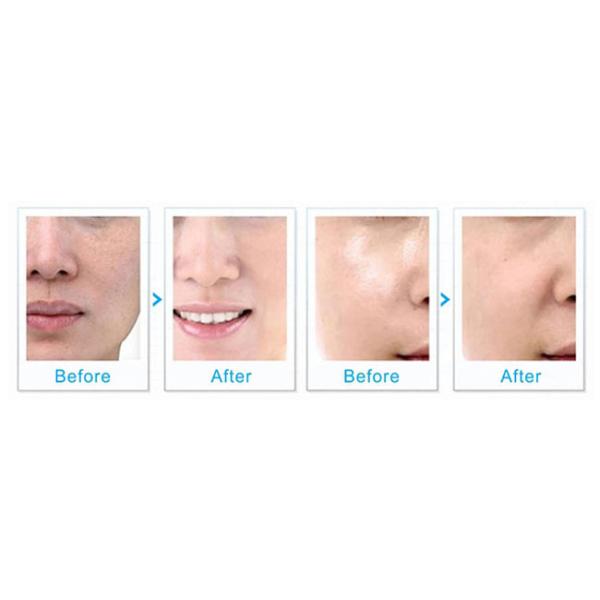 6 In1 Hydro Microdermabrasion Machine Vacuum And Water Circulation Inside