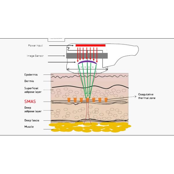 High Intensity Focused Ultrasound Hifu Anti wrinkle machine With Lasting Effect