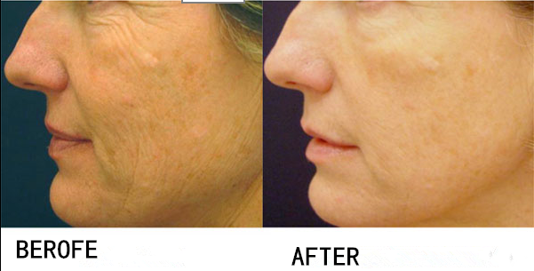 Non surgical high intensity focused ultrasound machine for wrinkle removal