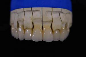 China Denture Fabrication Lab Achieving Perfectly White Dentures with Zirconia Repair wholesale