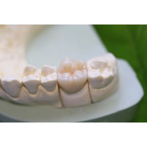 China Aesthethics Glass Ceramic EMAX Posterior Crowns For Molars wholesale