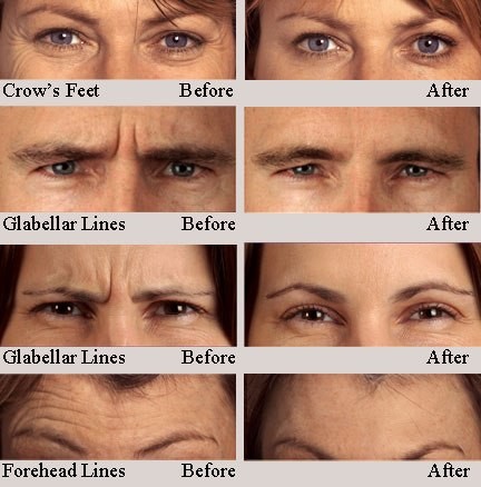 Korea Botulinum Injection For Wrinkles Folds Lose Weight