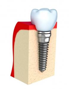 Dentures Temporary Dental Implant Bar Single All Ceramic Teeth