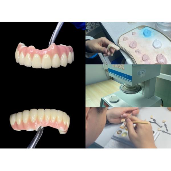 Polished Titanium Base dental Implant Ceramic Crown Bridge For Dental Restoration