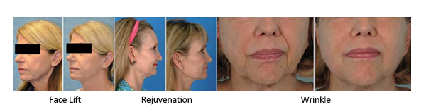 Medical Hifu Beauty Machine For Instant Wrinkle Removal And Face Lifting Body Slimming