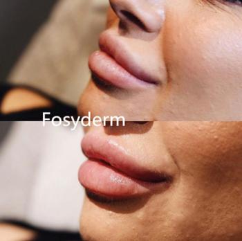 Transparent Dermal Lip Fillers For Lip Plump