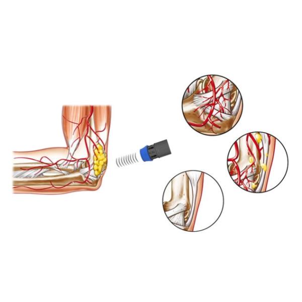 Vertical 16Hz Shockwave Therapy Machine China For Erectile Dysfunction