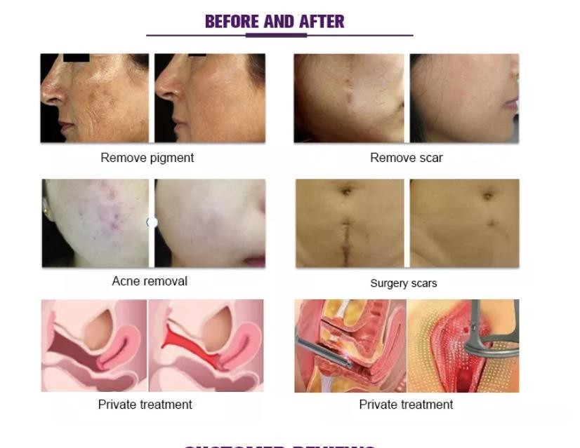 GOMECY 2024 Facial Skin Care Co2 Fractional Laser Stretch Mark Fractional Co2 Laser For Warts Scars Birthwarks Removal