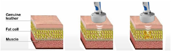 NEWS!!! Featured HIFUShape hifu slimming machine hifu ultherapy