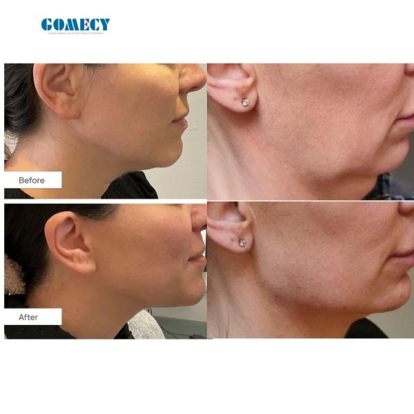 980nm Nail Fungus Removal Laser Machine Non Invasive Type Laser Treatment For Nail