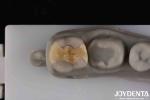 Low Translucency Inlay Onlay Secure Cementation For Long-Lasting And Aesthetic