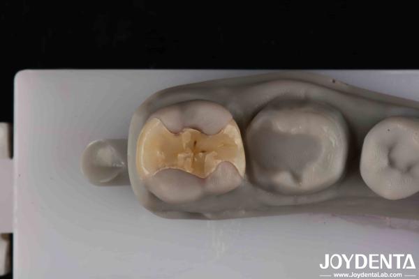 Low Translucency Inlay Onlay Secure Cementation For Long-Lasting And Aesthetic