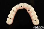 Durable Ti-Bar Zirconia Hybrid Bridge Made Of Titanium And Zirconia Materials