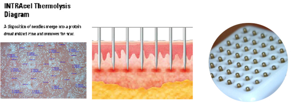 Nubway Insulated Fractional RF Microneedle Machine 50w For Wrinkle removal