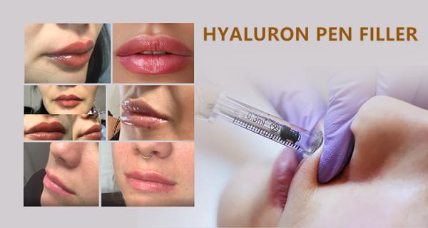 hyaluronic acid fillers lip fillers hyaluronic acid injections for pen and micro-needle treatment 2