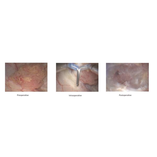 NephroBlast HD Kidney Stone Plasma Probe with Frequency Modulation