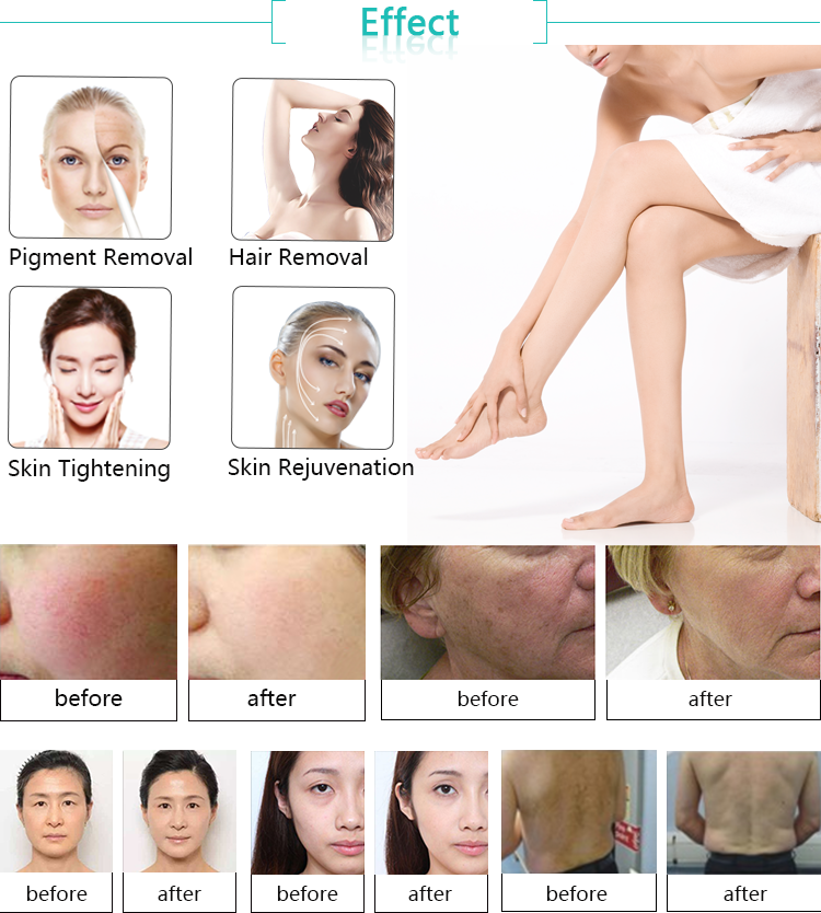 2018 high quality clinic use professional multifunction e-light ipl SHR hair removal technology