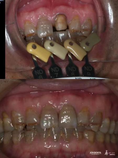 Translucency Zirconia Crowns Multilayered Gradient Technology For Optimal
