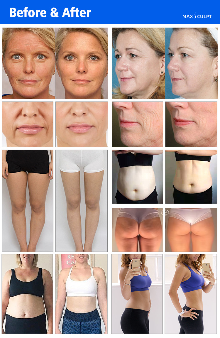 GOMECY Vela Body Slimming Vacuum RF Cavitation Roller Treatment Results