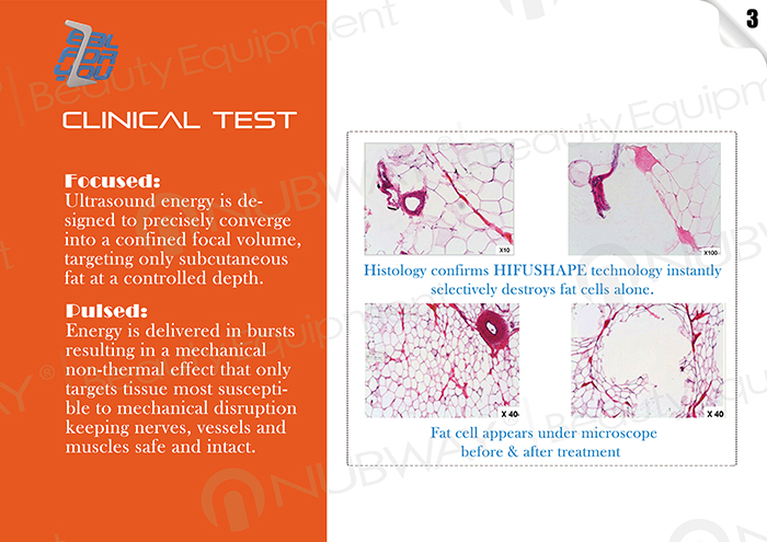 The most popular Liposonix HIFU for Body Slimming Machine / Ultrashape Liposonix Machine