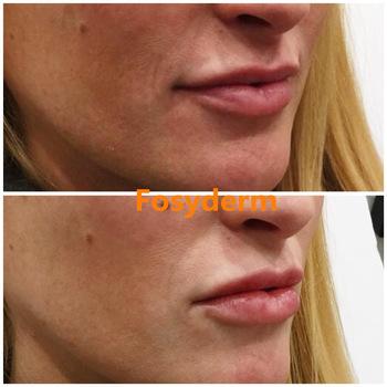 Transparent Dermal Lip Fillers For Lip Plump